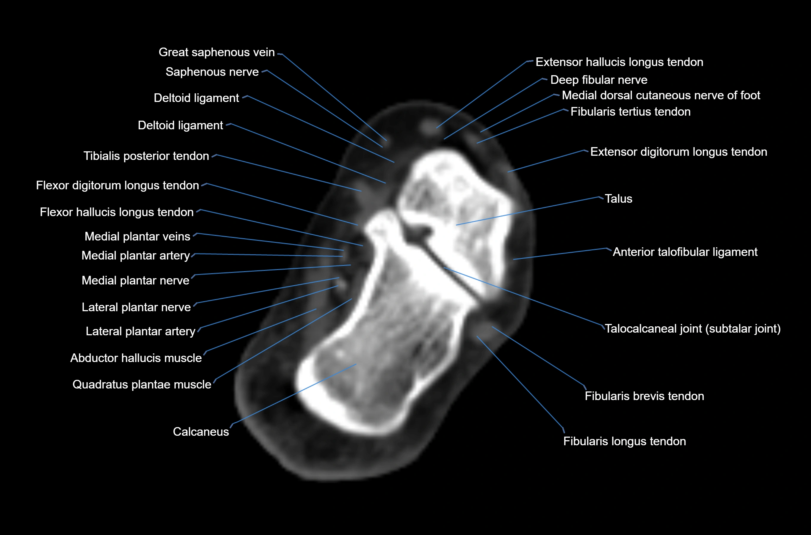 CT Ankle axial cross sectional anatomy labelled image -00037.webp